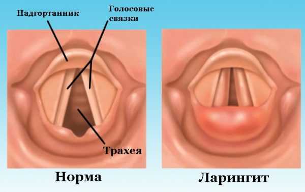 Трахеит