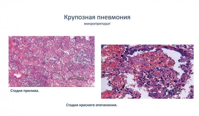 Пневмония. причины, симптомы, современная диагностика и эффективное лечение болезни. :: polismed.com