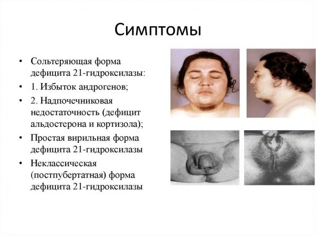 Адреногенитальный синдром - симптомы болезни, профилактика и лечение адреногенитального синдрома, причины заболевания и его диагностика на eurolab