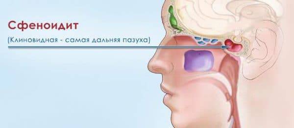 Как лечить острый и хронический сфеноидит?