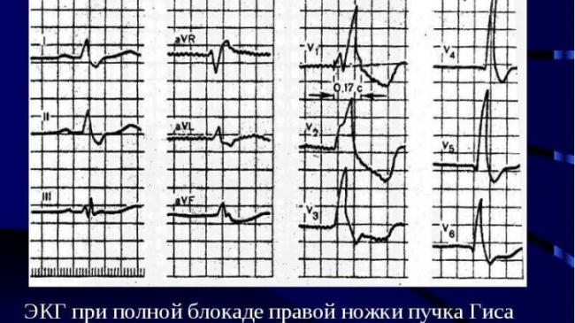 Блокада правой ножки пучка гиса: виды, диагностика на экг, лечение
