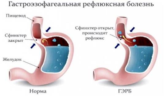 Чем лечить щекотание в горле, когда при этом хочется кашлять?