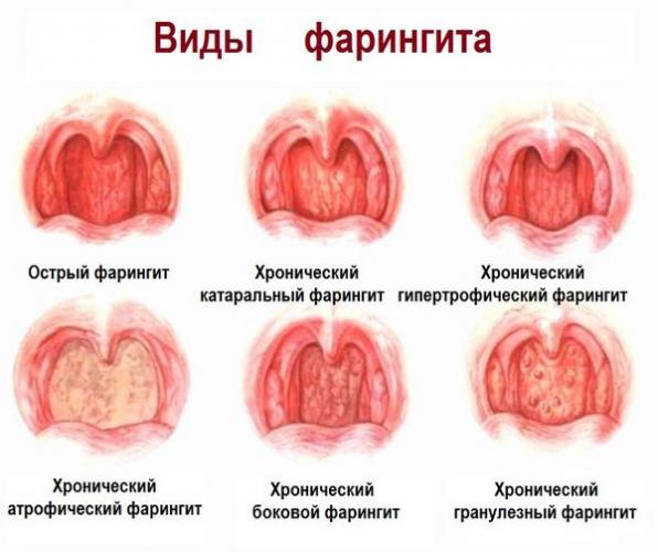 Хронический фарингит