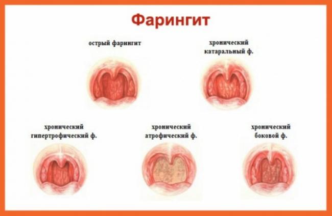 Как вылечить гранулезный фарингит?