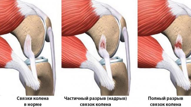 Растяжение связок коленного сустава: причины, симптомы и лечение
