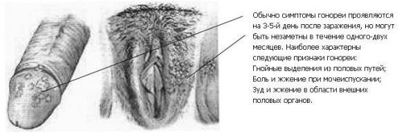 Гонорея