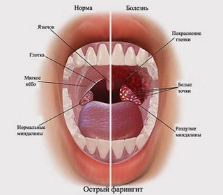 Боковой фарингит (острый и хронический): симптомы и лечение