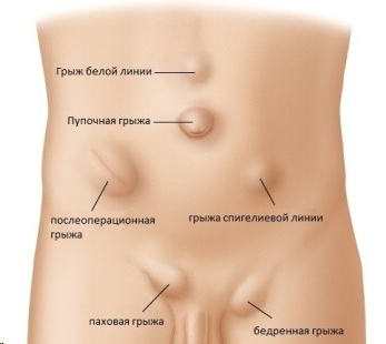 Паховая грыжа. причины, симптомы, диагностика и лечение