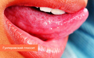 Глоссит: виды, симптомы, причины, лечение у взрослых
