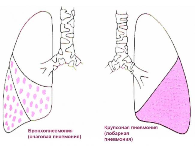 Крупозная пневмония