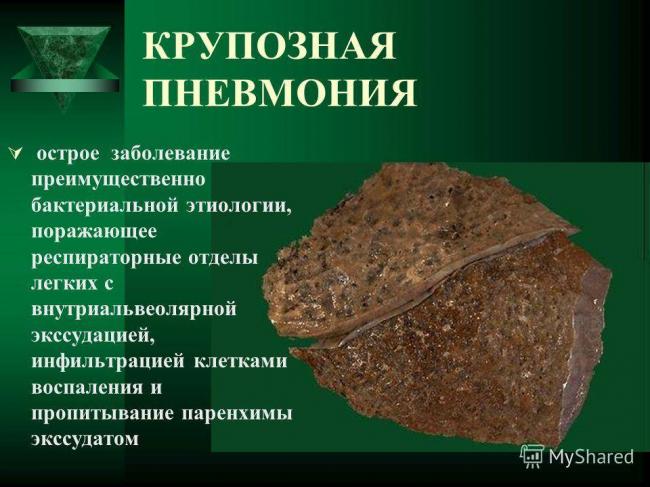Крупозная пневмония — медицинская википедия