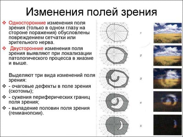 Скотома (темные пятна в поле зрения): что это такое?