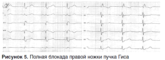 Неполная блокада правой ножки пучка гиса — что это такое, чем опасно?