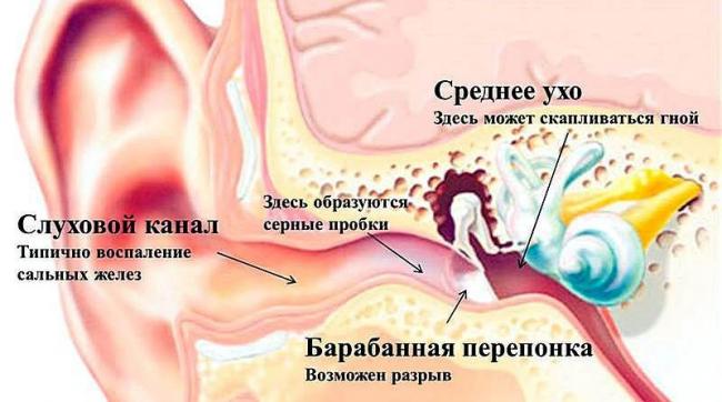 Причины, симптомы и лечение злокачественного наружного отита