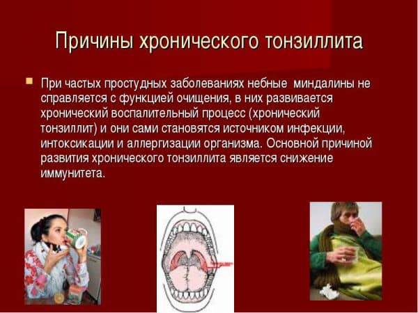 Тонзиллит у взрослых: как лечить и предупредить?