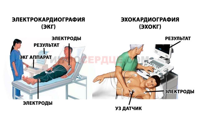 Симптомы предынфарктного состояния: как распознать и что делать