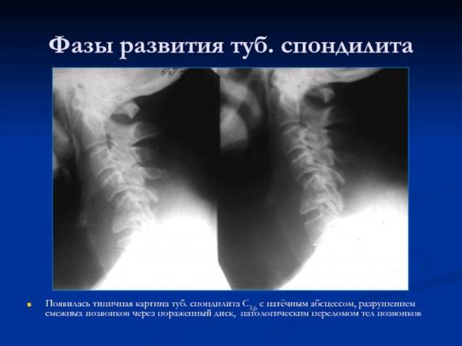 Туберкулез позвоночника