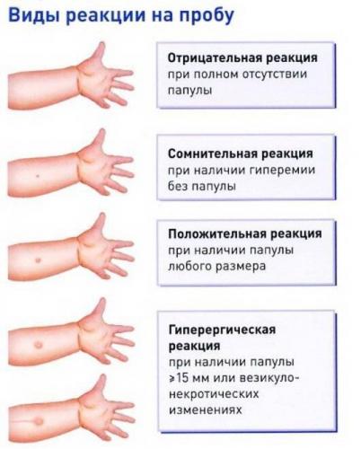 Диаскинтест
