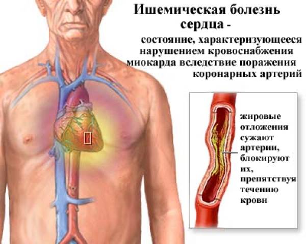Диета при ишемической болезни сердца