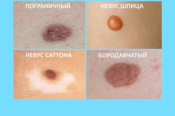 Невус рида. голубой невус. виды голубых невусов.