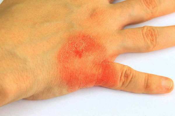 Симптомы аллергии на йод