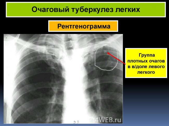 Самые эффективные антибиотики для лечения туберкулеза
