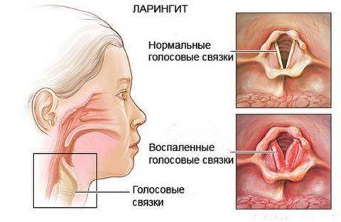Как лечить осипший голос у взрослого. народные средства, медикаменты, гомеопатия