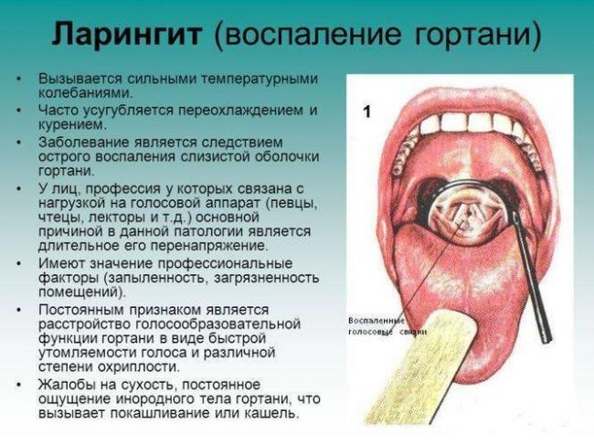 Лечение ларинготрахеита у взрослых препараты