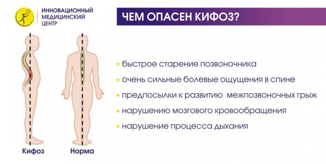 Кифоз шейного отдела позвоночника