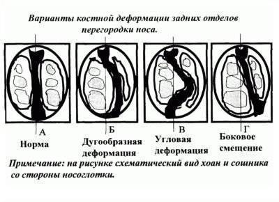 Искривление носовой перегородки у детей - симптомы болезни, профилактика и лечение искривления носовой перегородки у детей, причины заболевания и его диагностика на eurolab