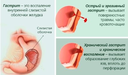 Питание при гастрите в период обострения (с повышенной и пониженной кислотностью) + примерное меню на неделю