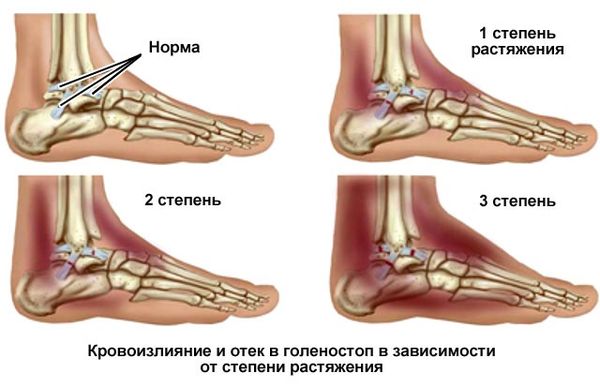 Восстановление и реабилитация связок коленного сустава после травмы