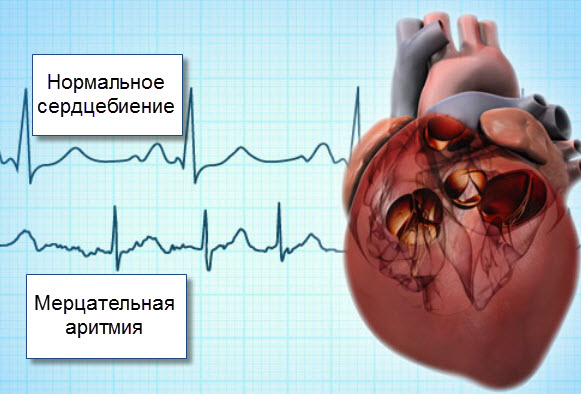 От чего мерцательная аритмия сердца — симптомы и методы лечения