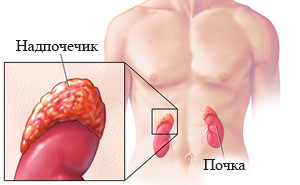 Адреногенитальный синдром: симптомы и лечение