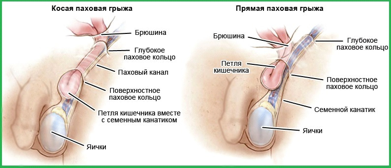 Паховая грыжа у мужчин