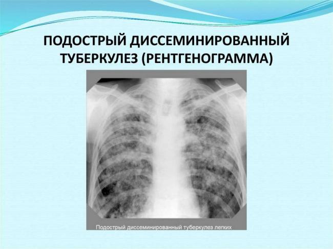 Очаговый туберкулез легких - дифференциальная диагностика