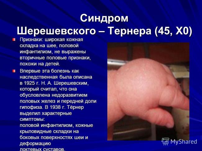 Половой генитальный инфантилизм, лечение. недоразвитие половых органов (инфантилизм)