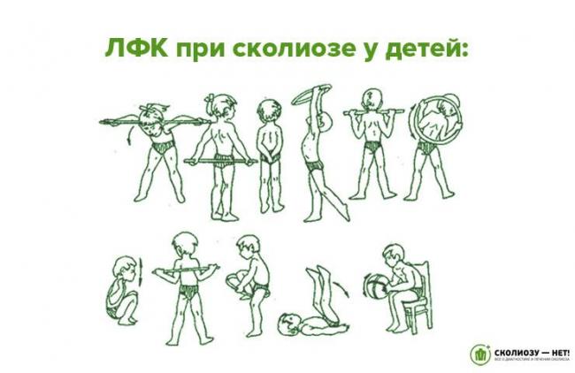 Упражнения лечебной гимнастики при кифосколиозе