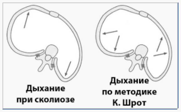 Дыхательная гимнастика шрот при сколиозе упражнения