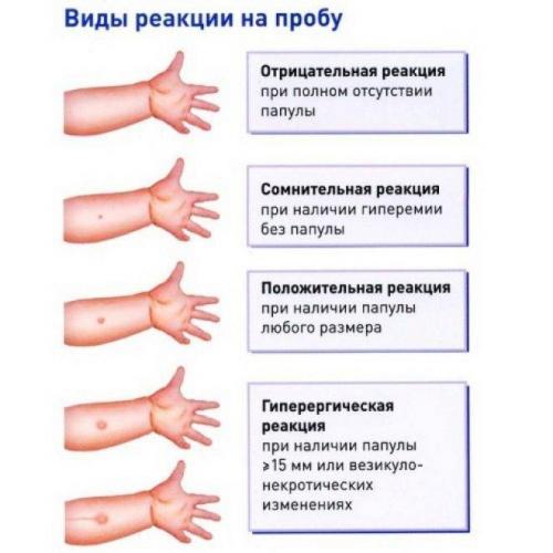 Можно ли делать манту старшему, если у младшего нет бцж?