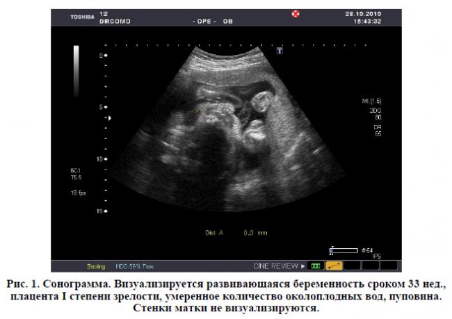 Внематочная беременность, эктопическая беременность