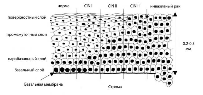 Цервицит – лечение на всех этапах заболевания