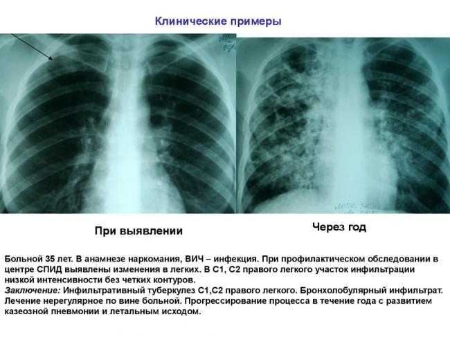 Витамин d помогает лечить смертельный лекарственно-устойчивый туберкулез