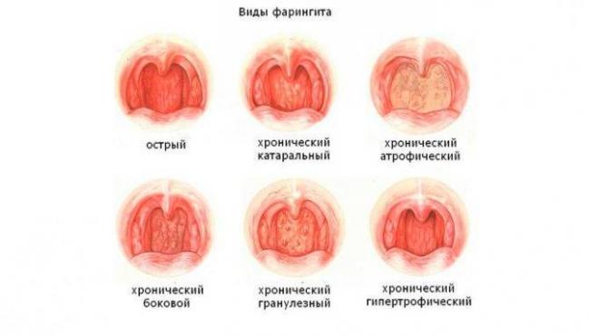 Хронический фарингит: симптомы и лечение