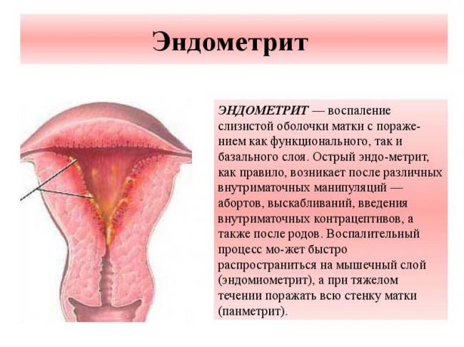 Эндометрит (воспаление матки) – симптомы и лечение. эндометрит и эндометриоз – в чем разница?