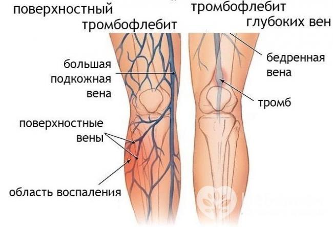 Что нельзя есть при тромбофлебите?
