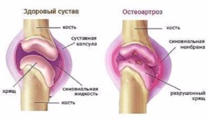 Ибупрофен: лечебный эффект и инструкция по использованию инъекций