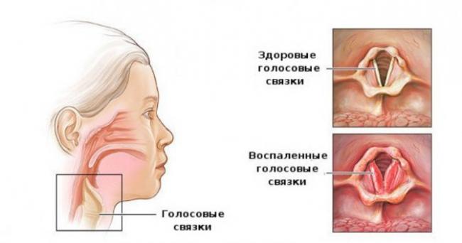 Пропал голос при ларингите: что делать?