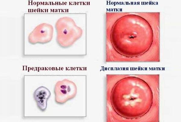 Заболевания шейки матки, лечение и профилактика