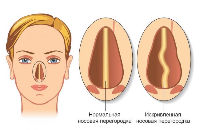 Симптомы и лечение искривления носовой перегородки